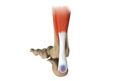 Achilles Tendon Bursitis