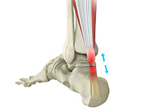 Achilles Tendon Rupture