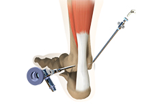 Ankle Arthroscopy