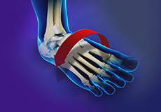 Ankle Instability