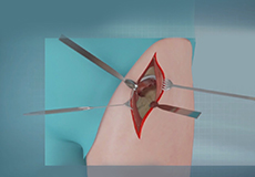 Direct Anterior Total Hip Replacement