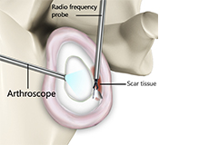 Capsular Release