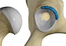 Hip Trauma Reconstruction