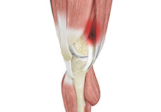 Iliotibial Band Syndrome