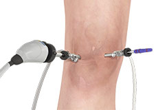 Knee Arthroscopy