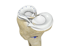 Meniscal Surgery