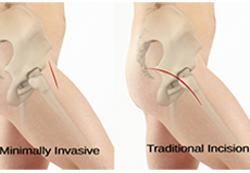 Minimally Invasive Total Hip Replacement