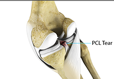 PCL Injuries