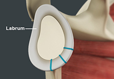 Shoulder Labrum Reconstruction