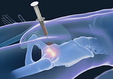 Stem Cell Therapy for Hip Injuries